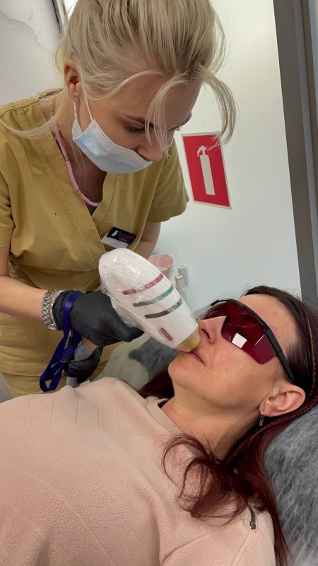 Лазерная эпиляция